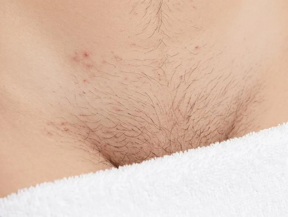 Strefa bikini przed depilacją laserową – widoczne włoski i podrażnienia